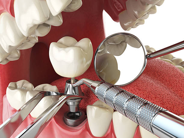 Urgent Tooth Repair in IL